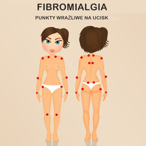 fibromialgia, bólowe punkty spustowe, grafika
